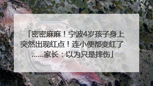 密密麻麻！宁波4岁孩子身上突然出现红点！连小便都变红了……家长：以为只是摔伤